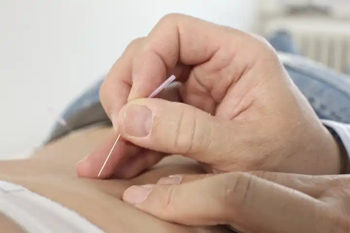 Arzt sticht Akupunkturnadel in Rücken