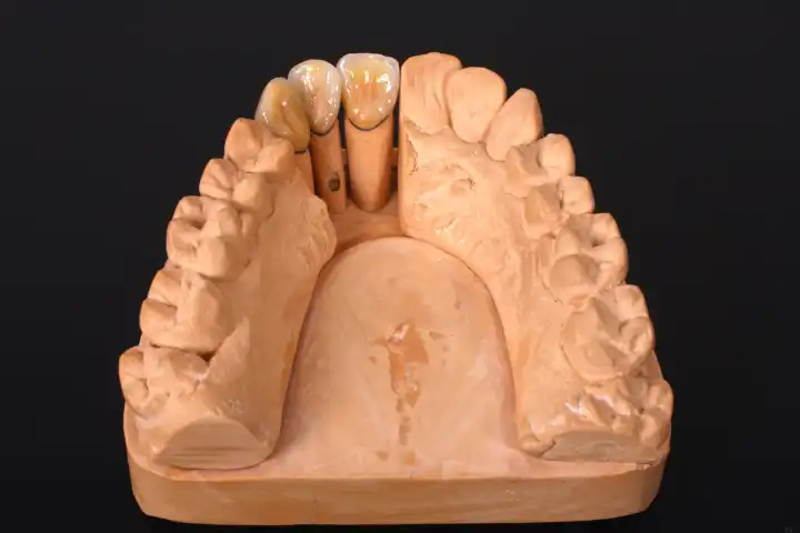 maxillary dental lab with metalceramic crowns