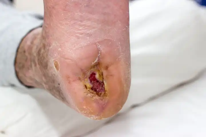 diabetic foot syndrome with ulcer