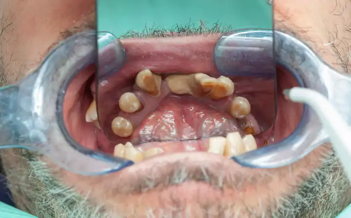 Verfaulte Zähne bei der Inspektion mit Retraktor für Zahnimplantatdesign.