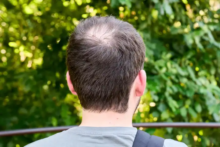 Der Hinterkopf von einem jungen Mann mit einer Halbglatze. Symbolbild Haarausfall